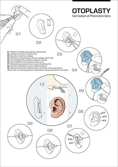 Otoplasty | Correction of prominent ears
