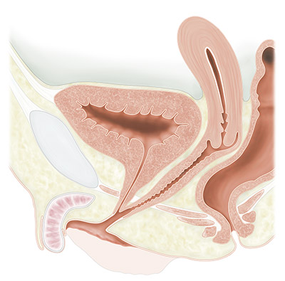 Virilization in CAH (Prader stage III)